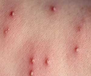 Fire Ant Bites