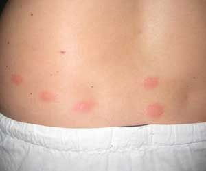 Bedbug Bites Back