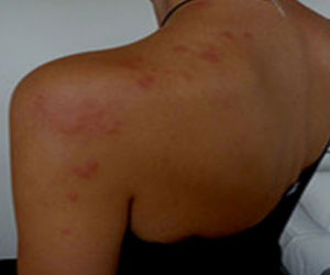 Bedbug Bites Shoulder